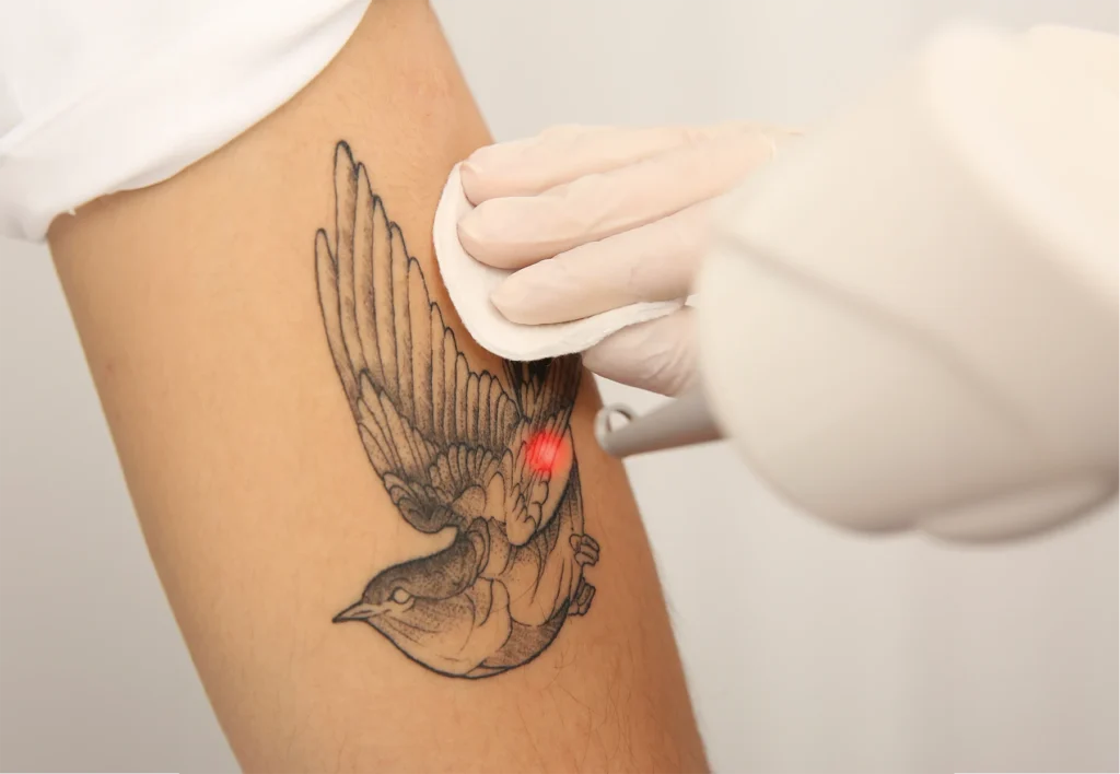 Tattoo Removal