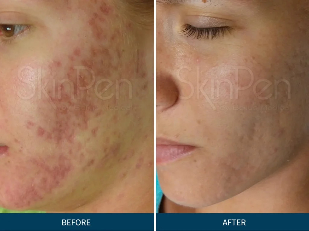 Micro Needling SkinPen