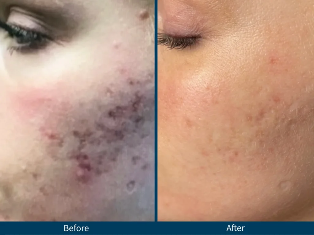Micro Needling SkinPen
