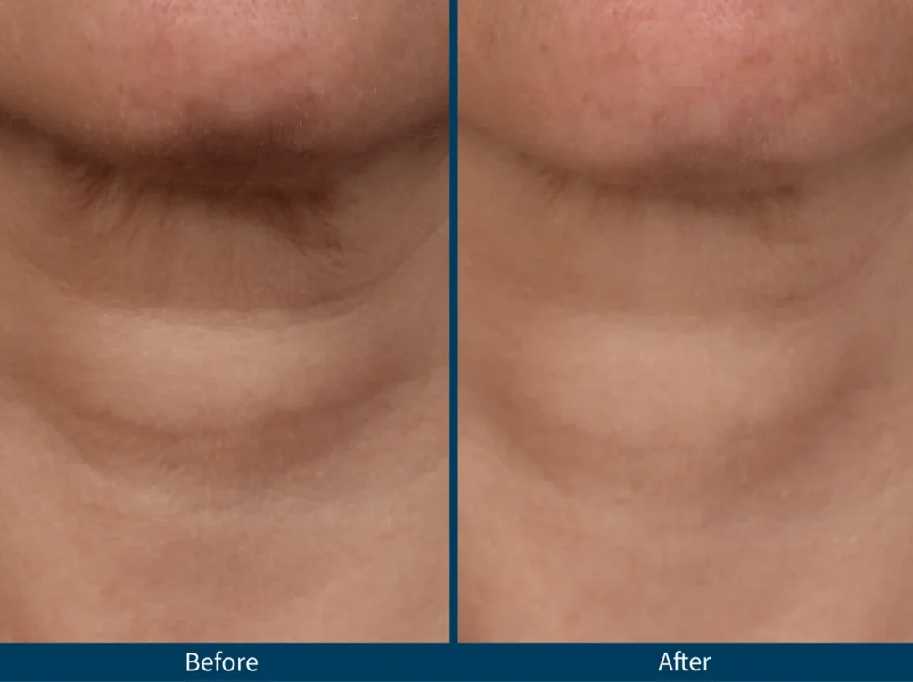 Micro Needling SkinPen